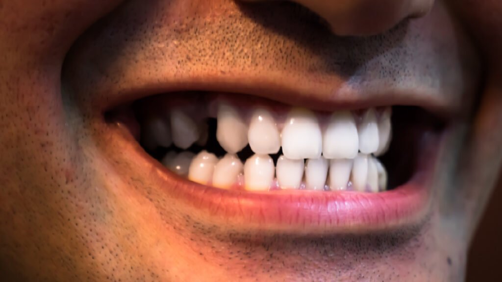 La pérdida de dientes: el inicio de una inestabilidad en tu mordida y la pérdida de eficiencia masticatoria